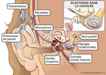 Les parties d'un implant cochléaire et leur emplacement dans et autour de l'oreille