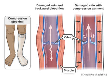 A damaged vein with backward blood flow and a damaged vein with compression garment allowing for better blood flow