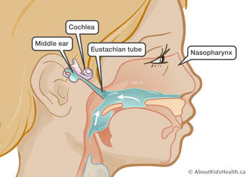 Fluid build up in the middle ear space that causes conductive hearing loss