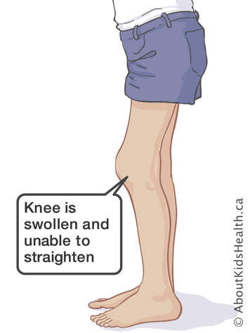 Lower body of child with a knee that is swollen and unable to straighten