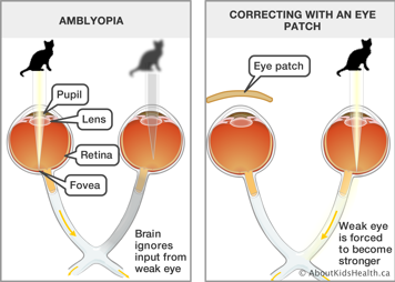 Comparison of vision with a lazy eye or amblyopia and vision corrected by an eye patch