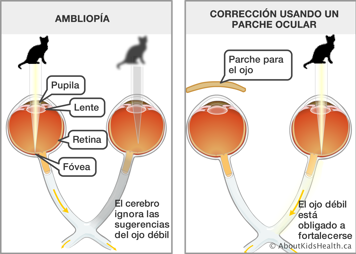 Comparación entre la visión con un ojo vago o ambliopía y la visión corregida con un parche ocular