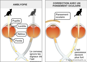Comparaison de la vision avec un œil parresseux ou l'amblyopie et la vision corrigée par un pansement oculaire