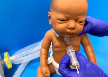 Removing the tracheostomy adaptor to suction the child after CoughAssist treatment