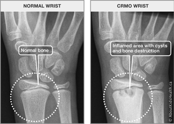 X-ray of normal wrist bone and x-ray of CRMO wrist with an inflamed area with cysts and bone destruction