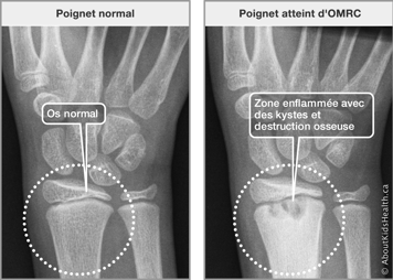 Radiographies d’un poignet normal et d’un poignet atteint d’OMRC avec zone enflammée avec des kystes et destruction osseuse