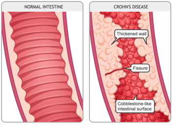 Close-up of a normal intestine and close-up of an intestine with Crohn&rsquo;s disease
