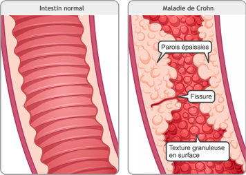 Gros plan sur un intestin normal et gros plan sur un intestin avec la maladie de Crohn