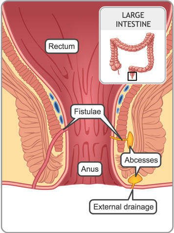 Rectum and anus with fistulae and abcesses
