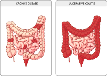 Intestines with Crohn&rsquo;s disease and intestines with ulcerative colitis