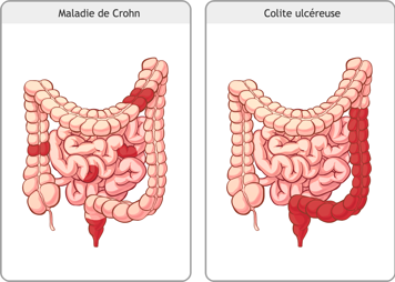 Intestins avec maladie de Crohn et intestins avec colite ulcéreuse