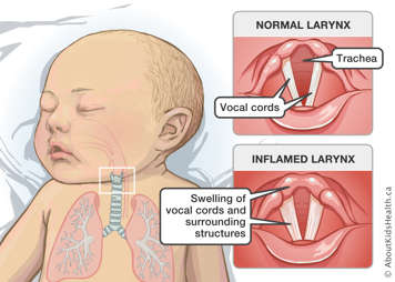 Normal larynx with trachea and vocal cords identified and inflamed larynx with swollen vocal cords and surrounding structures