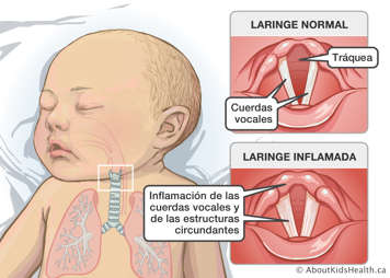 Laringe normal, tráquea y cuerdas vocales, y laringe inflamada con las cuerdas vocales y estructuras circundantes hinchadas