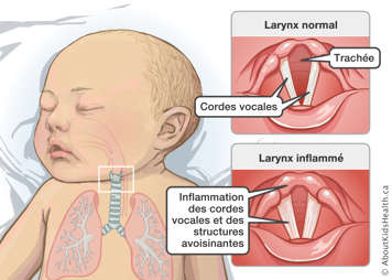 Un larynx normal avec la trachée et les cordes vocales identifiées et un larynx inflammé