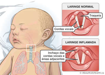 Laringe normal com traqueia e cordas vocais identificadas e laringe inflamada, com cordas vocais e áreas adjacentes inchadas