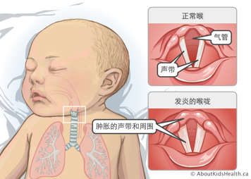 气管和声带明晰可见的正常喉部，以及声带和周围结构肿胀的发炎喉部