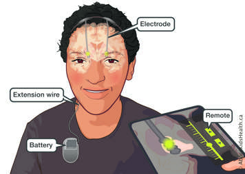 Illustration of child showing placement of electrodes, extension wire and battery with external remote