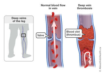 Side-by-side of normal blood flow in vein and deep vein thrombosis