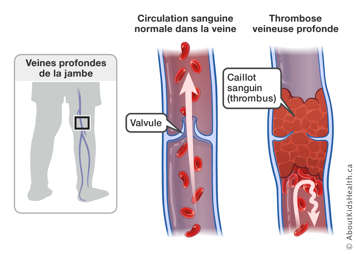 Illustration de la circulation sanguine normale dans la veine et de la thrombose veineuse profonde