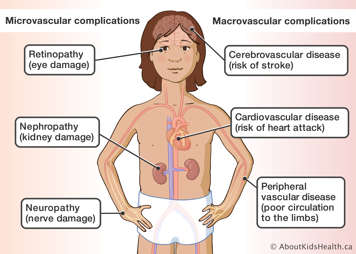 Body parts affected by microvascular and macrovascular diabetes complications highlighted 