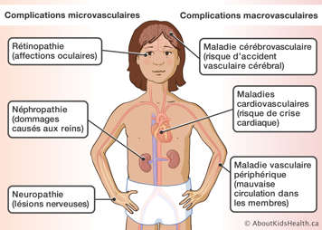Revue des parties du corps touchées par les complications microvasculaires et macrovasculaires liées au diabète