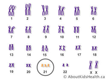 Les vingt-trois paires des chromosomes avec un chromosome 21 supplémentaire