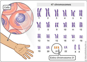 Cells containing 23 pairs of chromosomes, with an extra chromosome 21