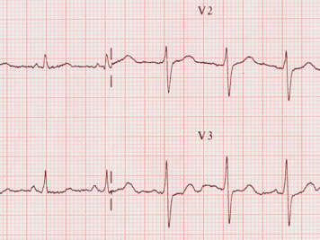 Modèle d'un électrocardiogramme
