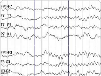 Patterns of EEG (Electroencephalogram)