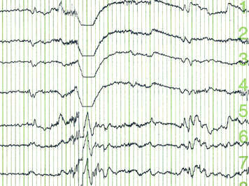 EEG patterns