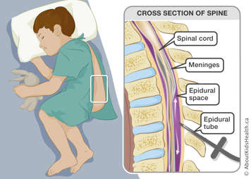 Cross-section of spine showing spinal cord, meninges, epidural space and epidural tube with arrows showing fluid movement