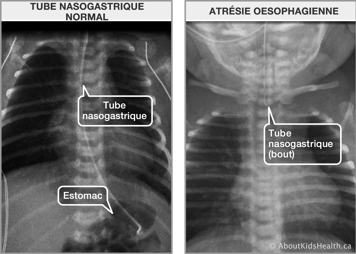 Rayon-x d’un sonde naso-gastrique normal et rayon-x d’un cas d’atrésie sophagienne