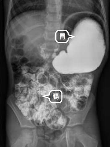 胃腸X光透視