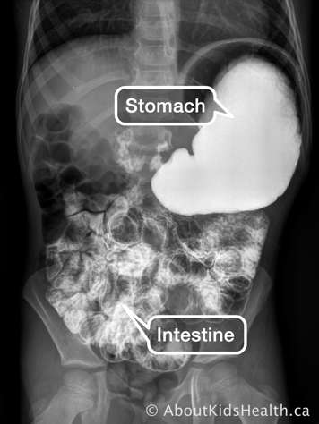X-ray of stomach and intestines