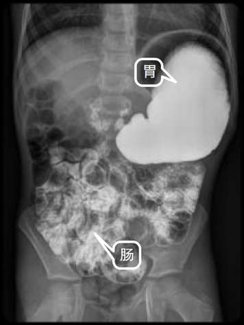胃肠X光透视