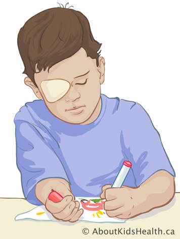 Boy colouring while wearing an eye patch over one eye