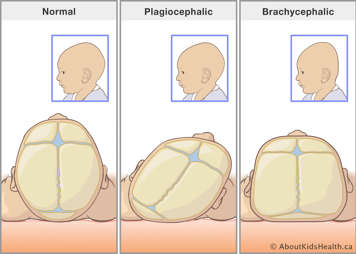 Normal head shape, plagiocephalic head with flattening on one side of head, and brachycephalic head with flattening of entire back of head