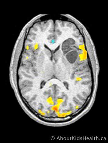 fMRI scan of the brain