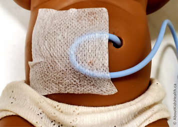 Foley catheter taped to the abdomen