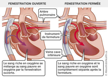 La circulation sanguine dans un cœur avec la fenestration ouverte et dans un cœur avec un instrument de fermeture