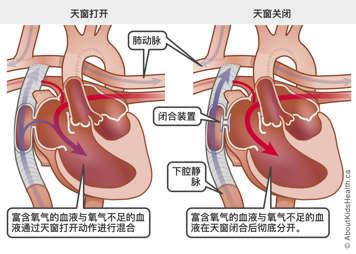 丰唐手术后窗口闭合是结束含氧血和缺氧血的分离。插图显示了连接下腔静脉和肺动脉的心外管道