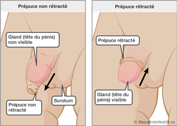 Un pénis avec prépuce non rétracté et gland non visible et un pénis avec prépuce rétracté et gland visible