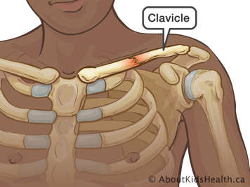 Fractured clavicle