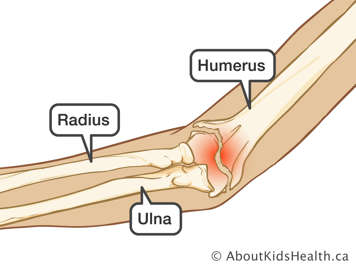 Fractured elbow affecting the humerus, radius and ulna