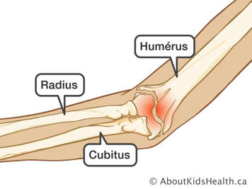 Fracture du coude affectant l’humérus, le radius et le cubitus