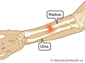 Forearm with fractured radius