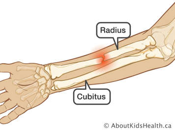 L’avant-bras avec une fracture du radius
