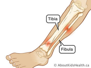 Lower leg with fractured tibia and fibula