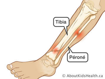 Bas de la jambe avec une fracture du tibia et une fracture du péroné