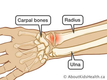 Wrist with fractured radius